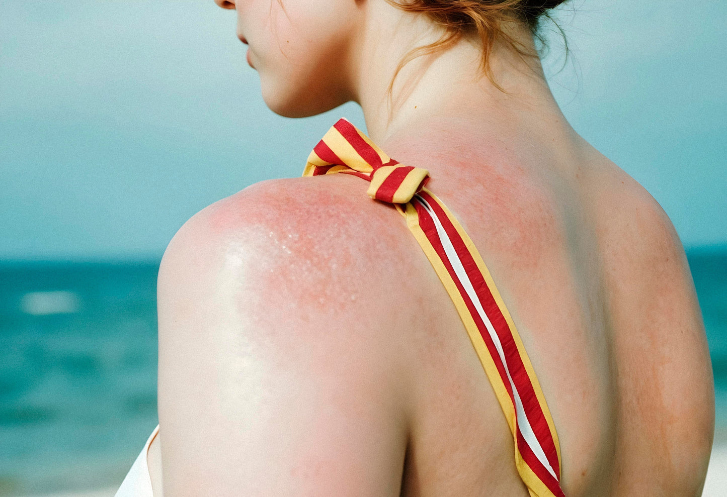 Sun Rash: Symptoms, Treatment, and Prevention